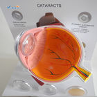 Glaucoma Model Plastic Eyes Models Eye Diseases Model Cataract Eye Model