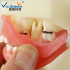 Peridontal Disease Teeth Study Model Human Dental Model Gingival Diseases