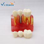 Decayed Tooth Orthodontic Study Models 4 Times Caries Disassembling Model