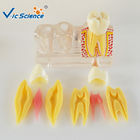 Decayed Tooth Orthodontic Study Models 4 Times Caries Disassembling Model