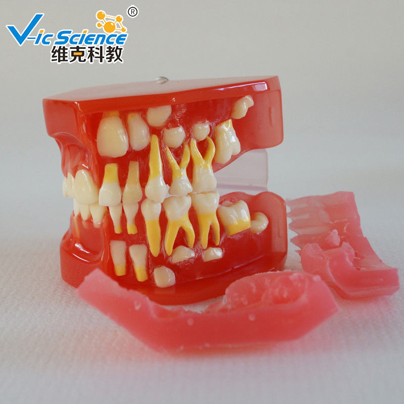 Advance PVC Plastic Child Caries Teeth Model Dental Life Size Eco - Friendly